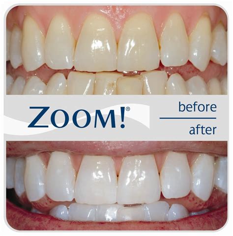 cost of zoom whitening.